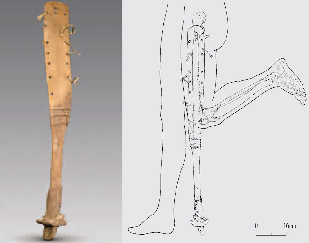 Prosthetic leg discovered in ancient Chinese tomb